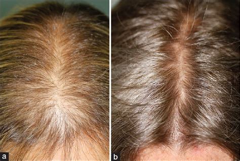 finasteride dosage for hair